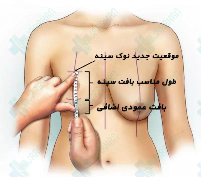درمان افتادگی سینه با عمل لیفت سینه
